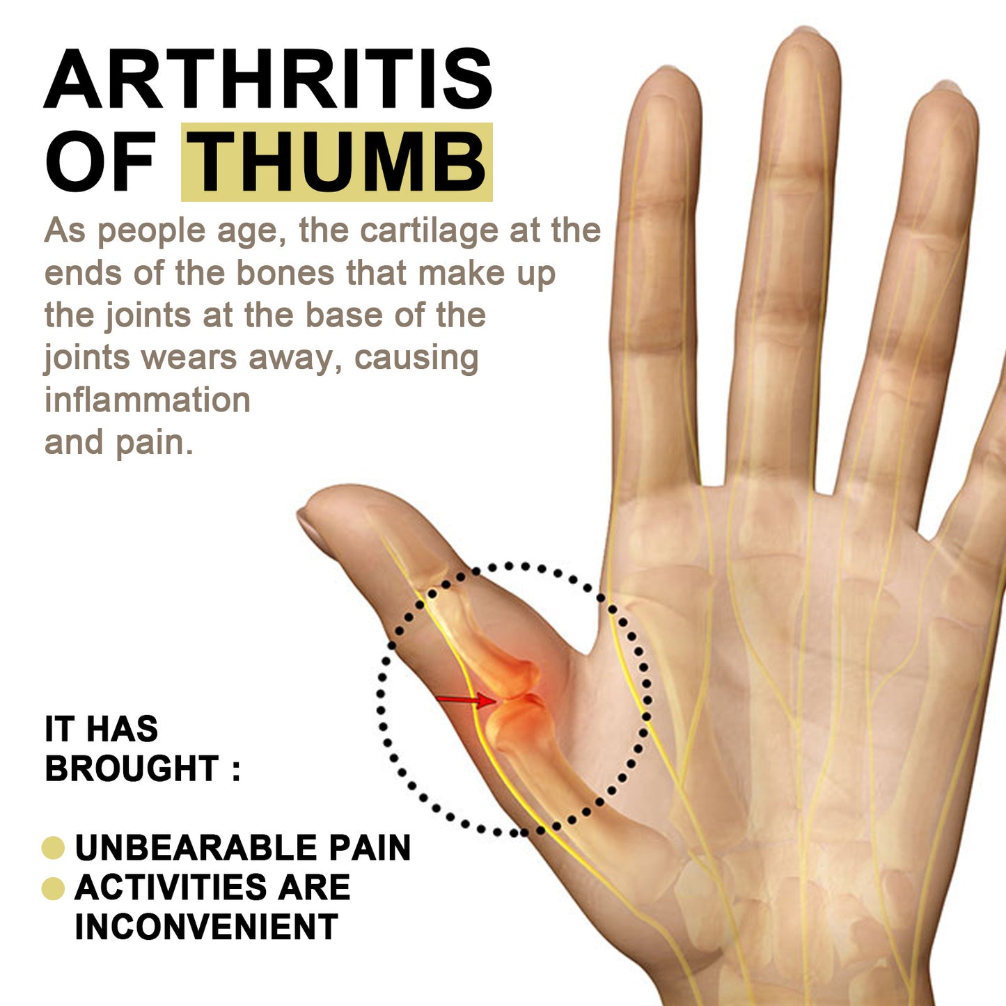 South Moon Arthritis Patch Tendon Sheath Treatment Hand Wrist Thumb Finger Pain Relief Plaster Rheumatoid Joint Pain Care Patch(12pcs)