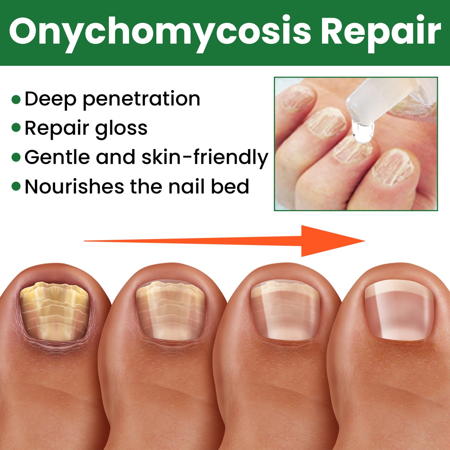 EELHOE Onychomycosis Treatment Oil Toenail Fungus Nail Fungal Infection Removal Paronychia Repair Essence Foot Nail Care Liquid(20ml)