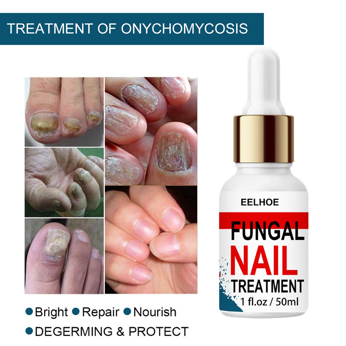 EELHOE Nail Onychomycosis Repair Nail Smoothing Serum