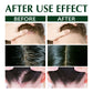 South Moon Hair Psoriasis Shampoo Seborrheic Dermatitis Treatment Eczema Scalp Itching Hair Anti Dandruff Antibacterial Shampoo(100ml)